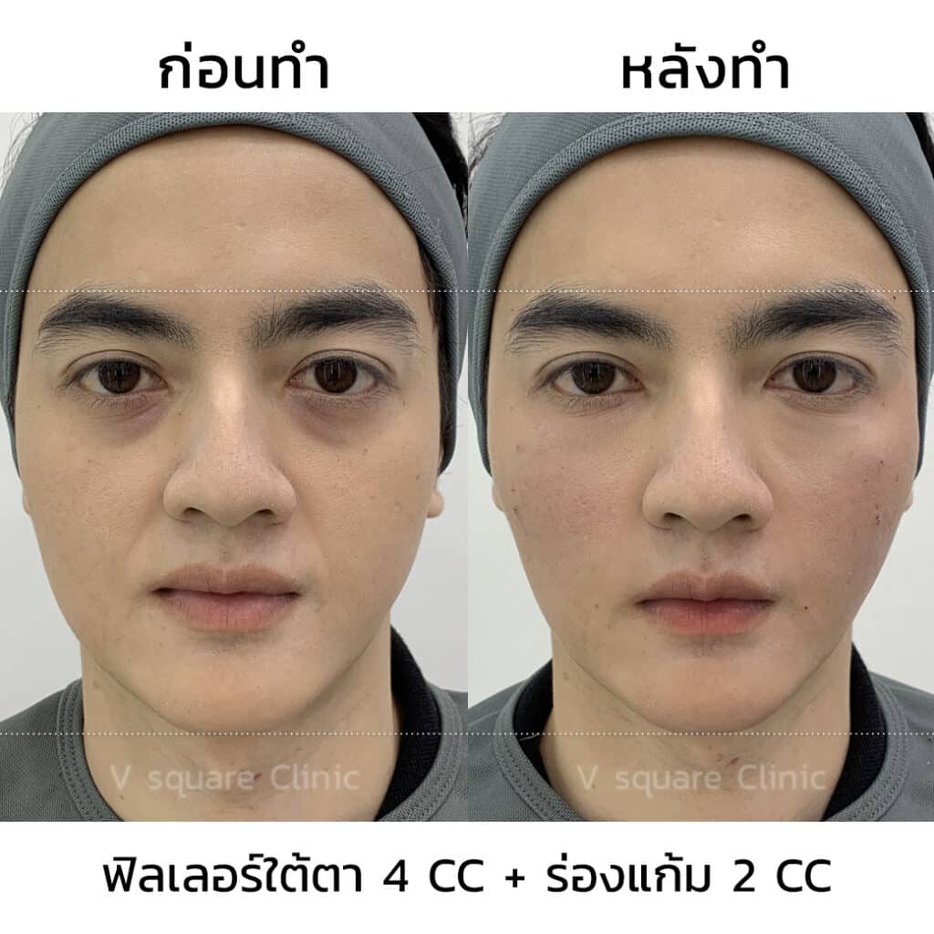 รีวิวฉีดฟิลเลอร์ใต้ตา