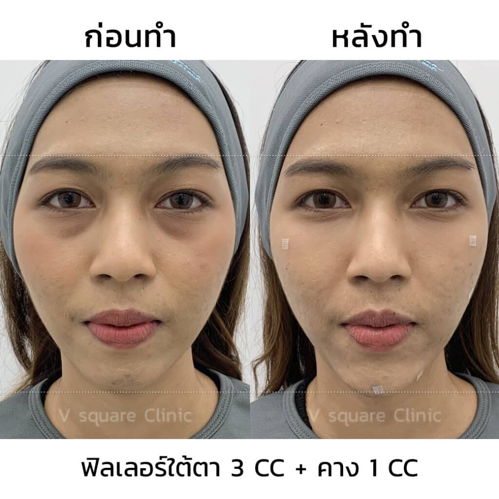 รีวิวฉีดฟิลเลอร์ใต้ตา