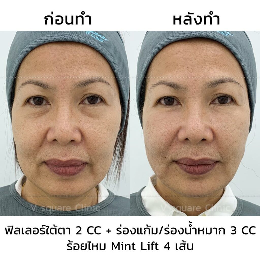 รีวิวฉีดฟิลเลอร์ใต้ตา