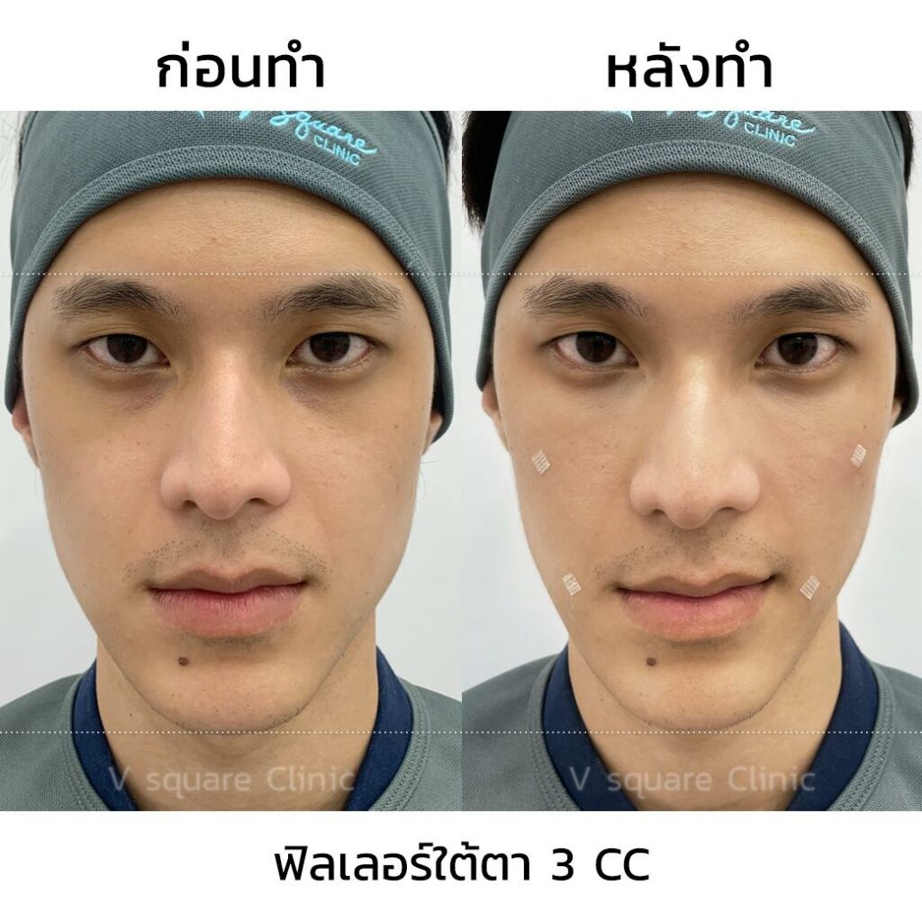 รีวิวฉีดฟิลเลอร์ใต้ตา