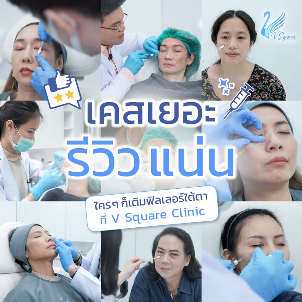 รีวิวฉีดฟิลเลอร์ใต้ตาที่ V Square Clinic โดย หมอต้น และหมอซี