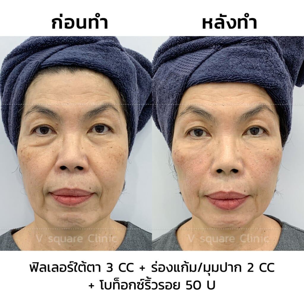 รีวิวฉีดโบท็อกลดริ้วรอย