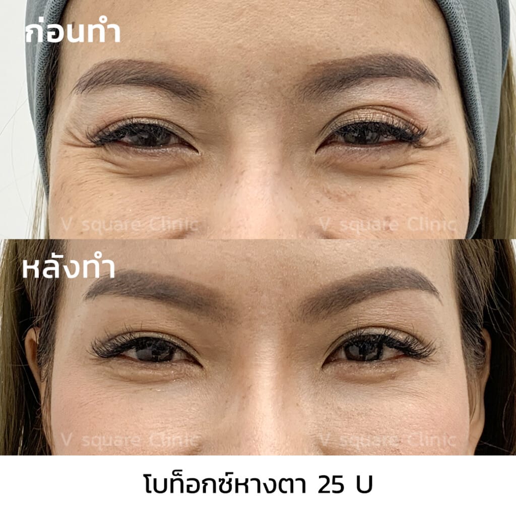 รีวิวฉีดโบท็อกลดริ้วรอยหางตา