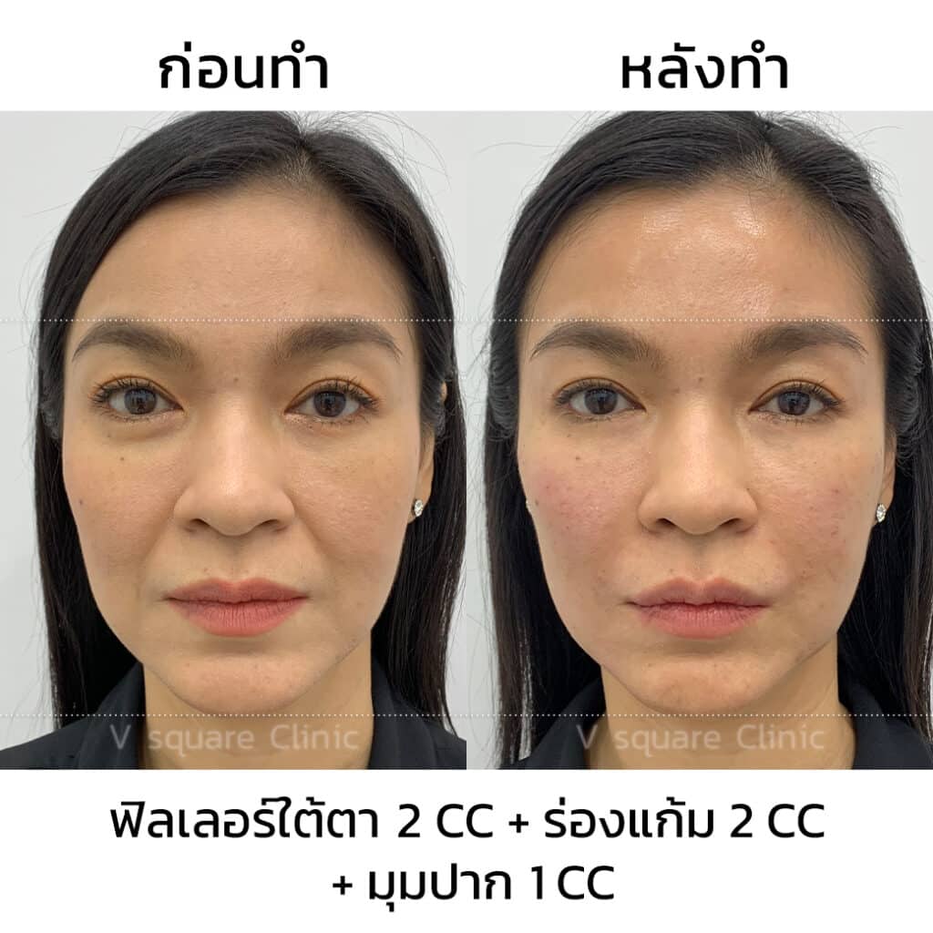 รีวิวฟิลเลอร์