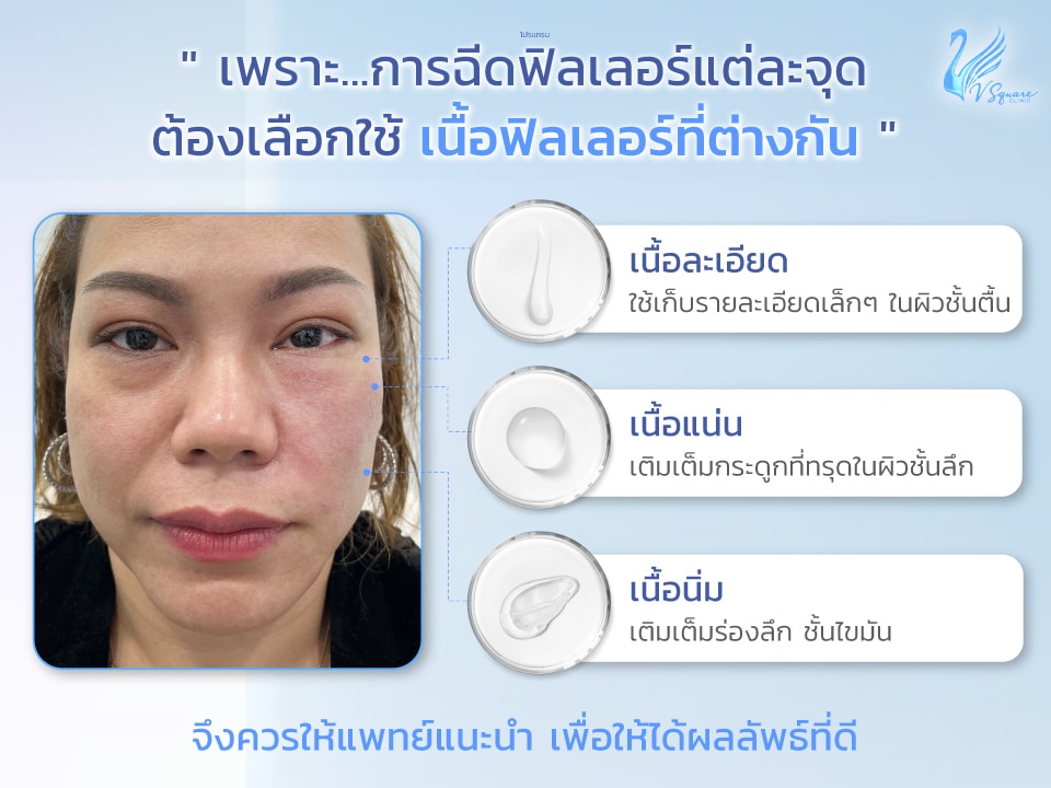 ประเภทของฟิลเลอร์