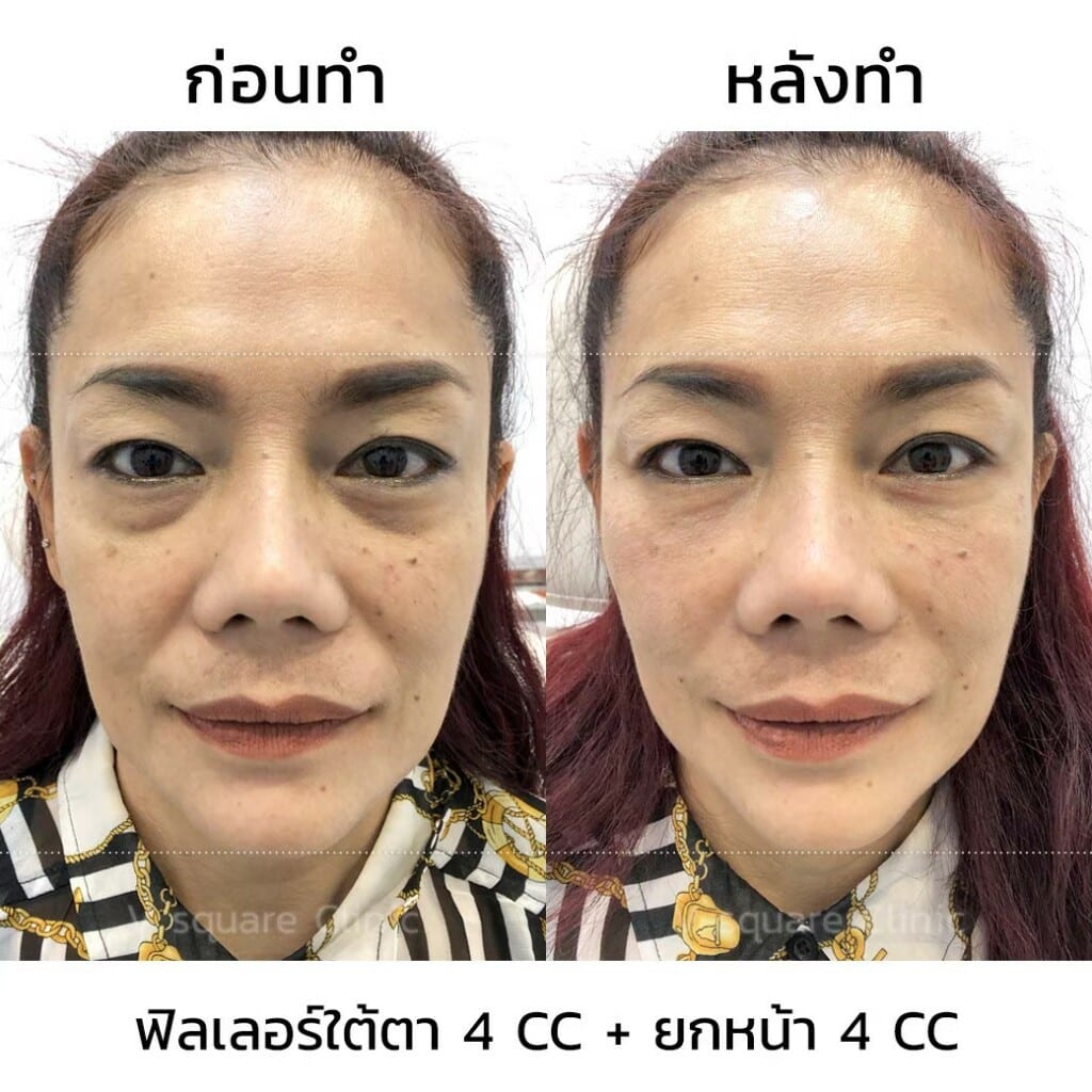 รีวิว filler ยกหน้า