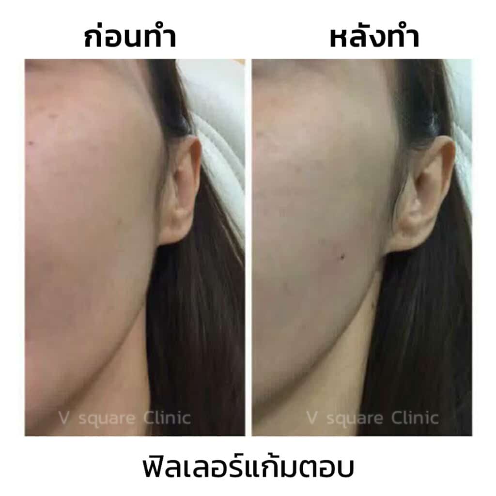 รีวิว filler แก้มตอบ