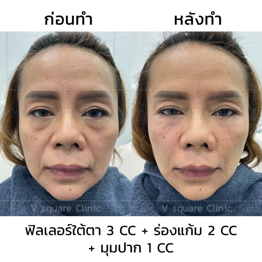 รีวิว ฟิลเลอร์ยกหน้า