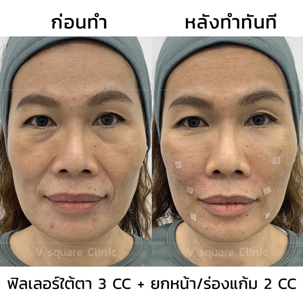 รีวิวฉีด filler ยกหน้า