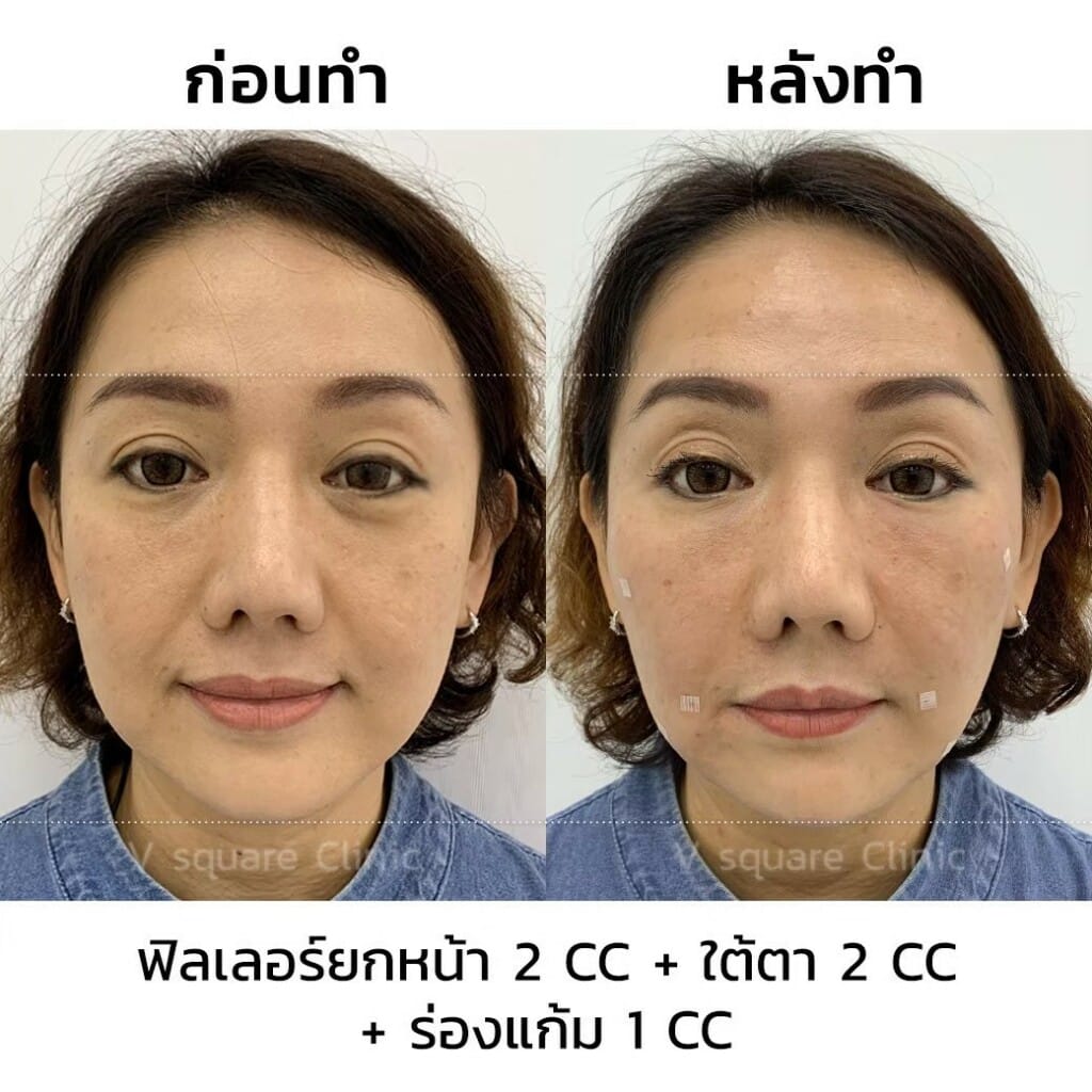 รีวิวฉีดฟิลเลอร์ยกหน้า