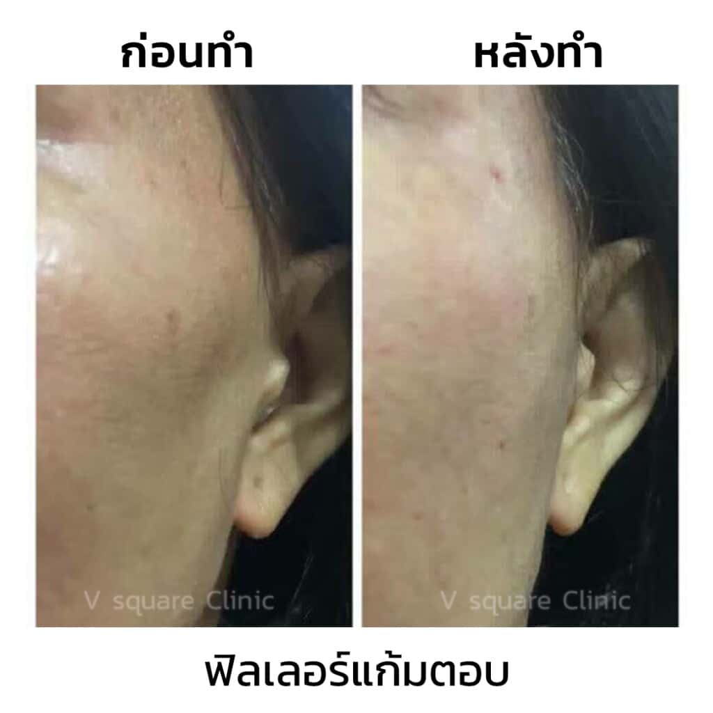 รีวิวฉีดฟิลเลอร์แก้มตอบ