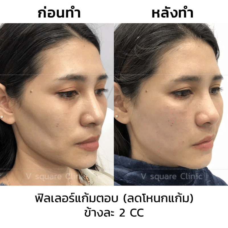 รีวิวฟิลเลอร์แก้มตอบ 2 cc