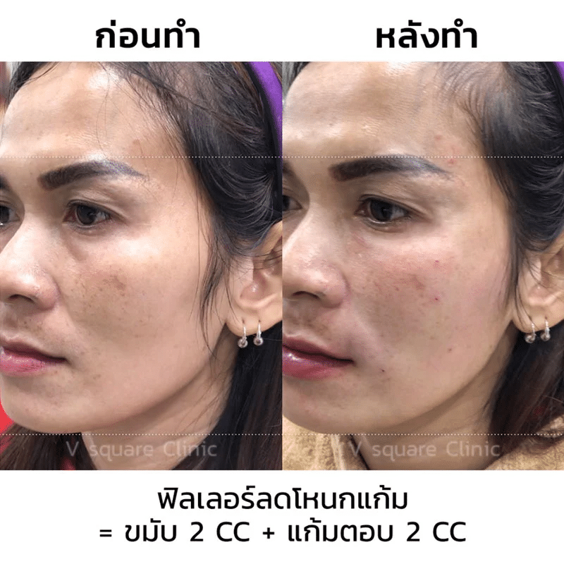 รีวิวฟิลเลอร์แก้มตอบ