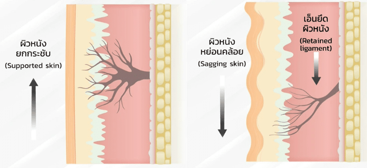 เส้นเอ็นยึดผิวหนังหย่อนลงเมื่ออายุมากขึ้น