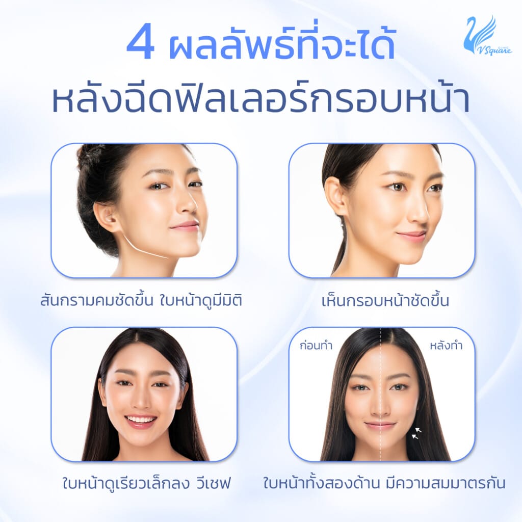 4-ผลลัพธ์ที่จะได้หลังฉีดฟิลเลอร์กรอบหน้า