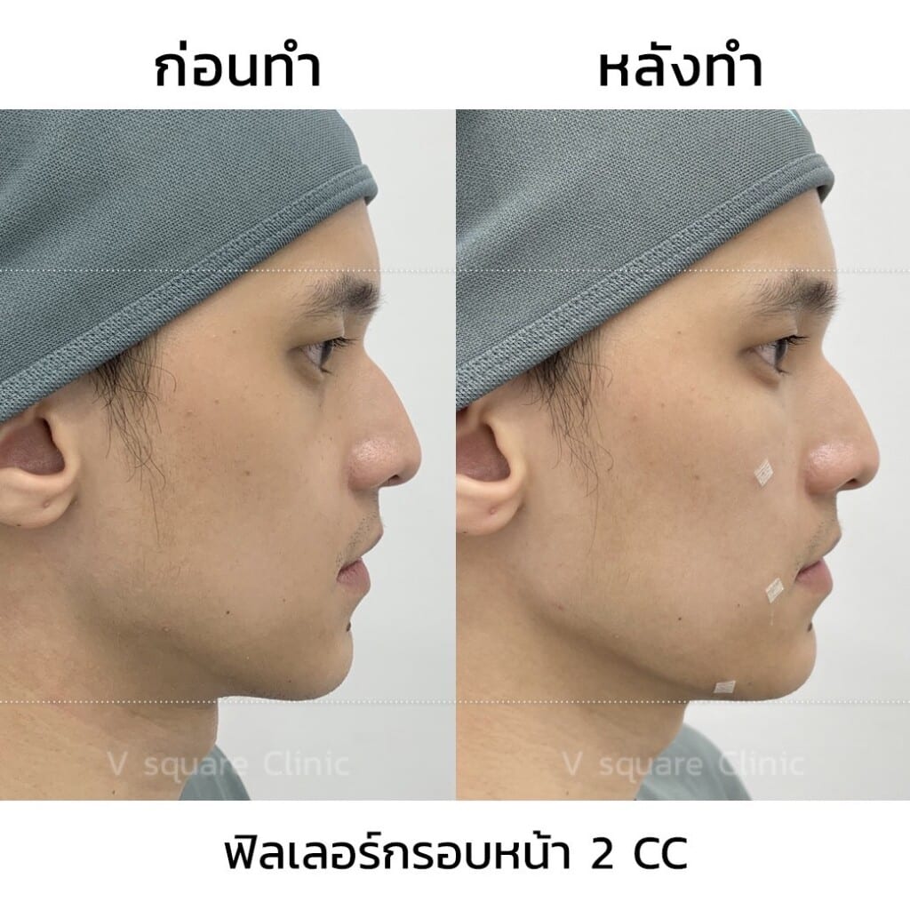 ฟิลเลอร์กรอบหน้า รีวิว