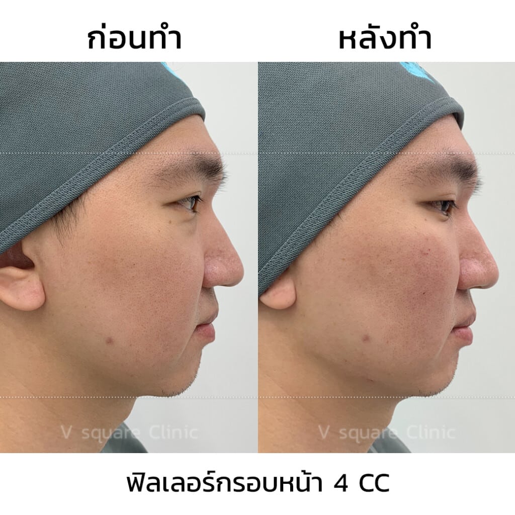 รีวิวฟิลเลอร์กรอบหน้า