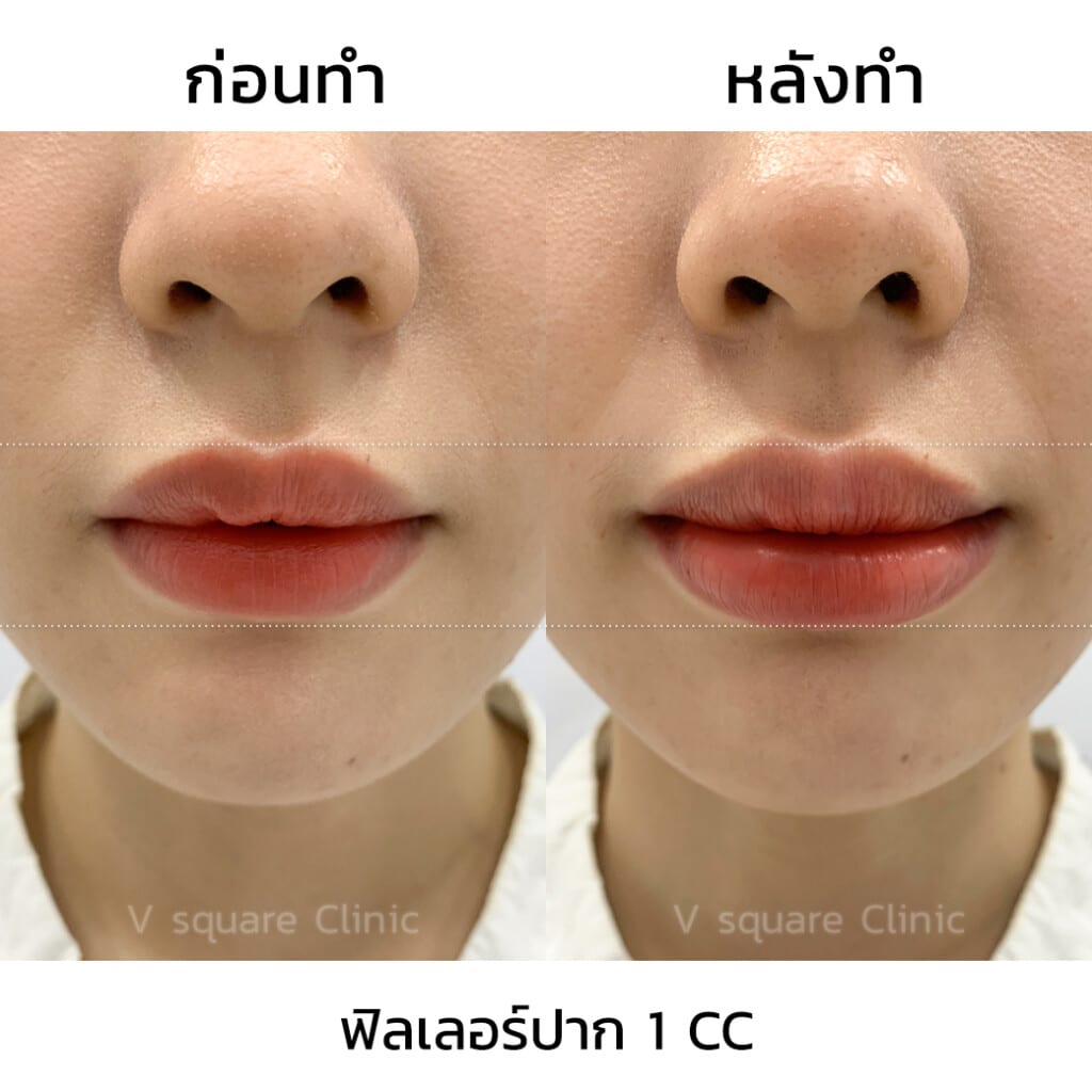 รีวิวฟิลเลอร์ปาก 1 CC