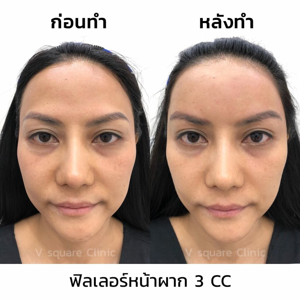 รีวิวฟิลเลอร์หน้าผาก 3 CC