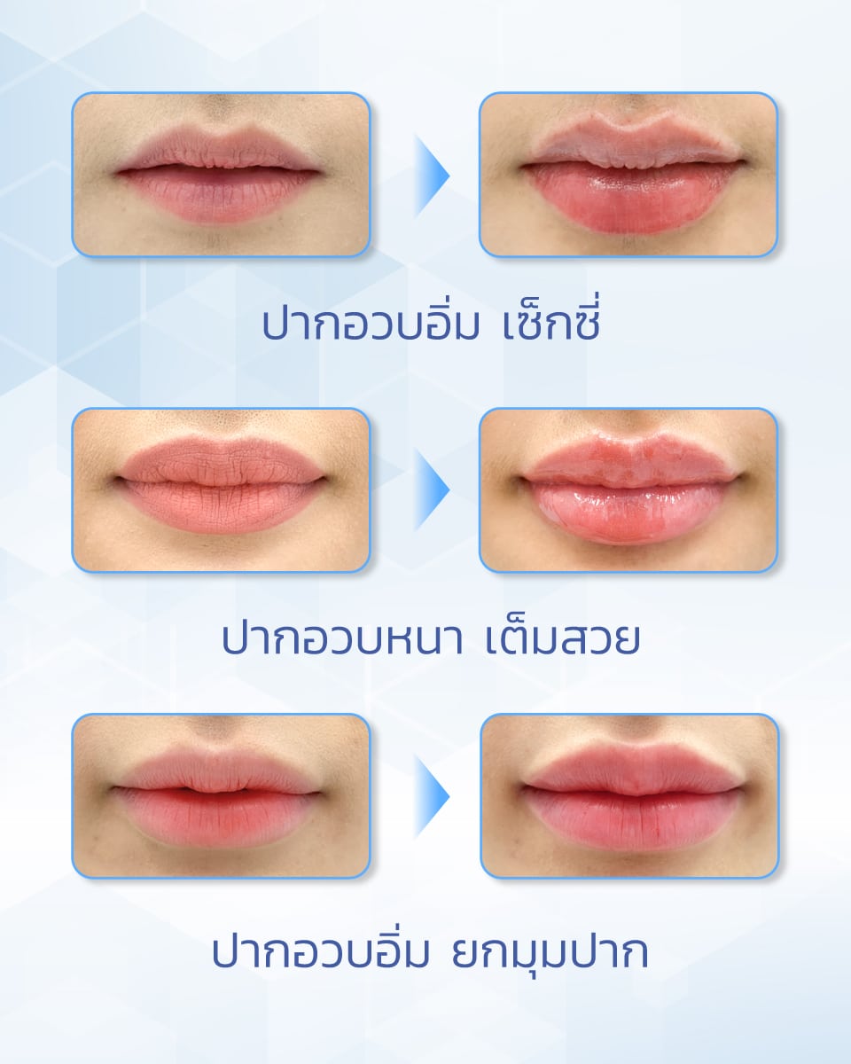 Restylane Kysse รีวิว