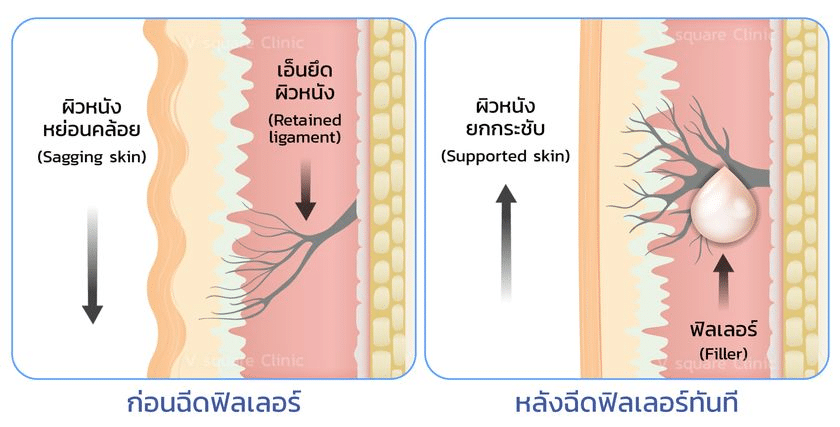 การทำงานของฟิลเลอร์ร่องน้ำหมาก