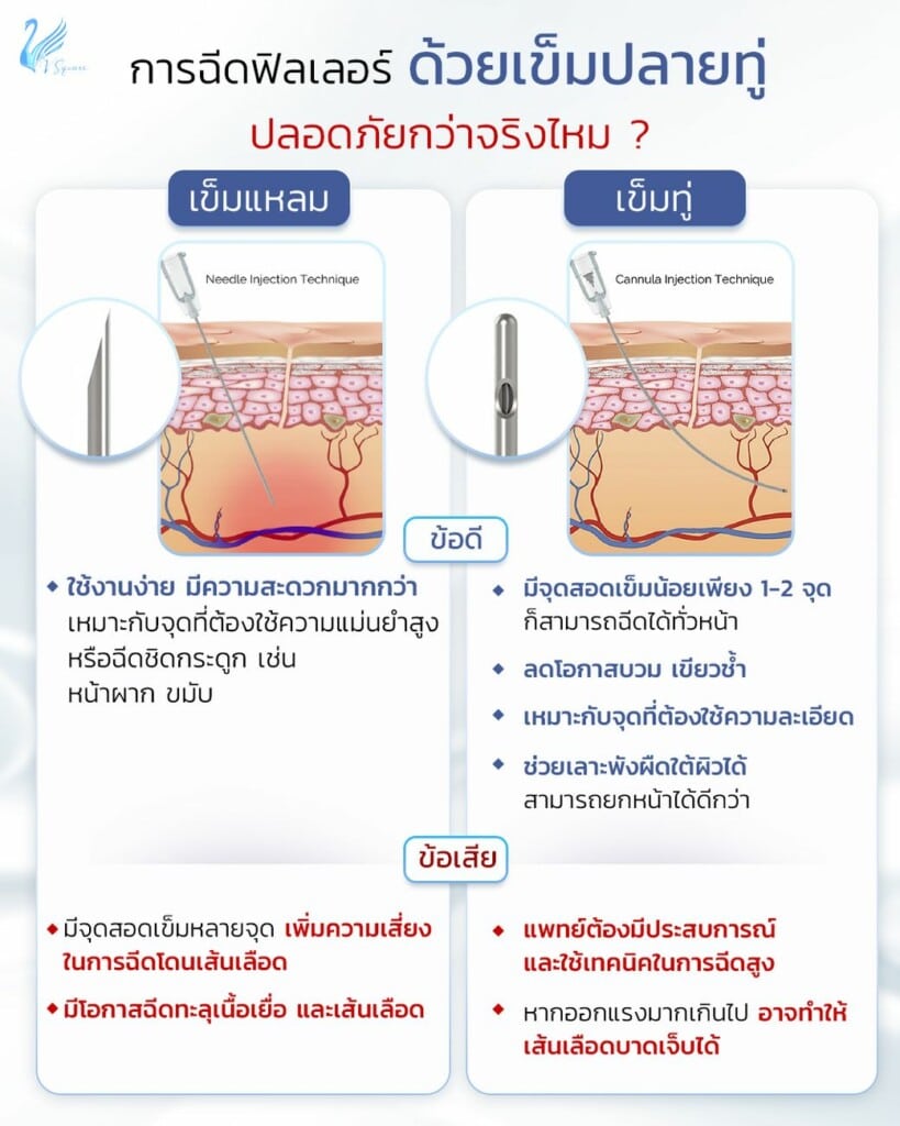 ฉีดฟิลเลอร์เข็มทู่ ข้อดี