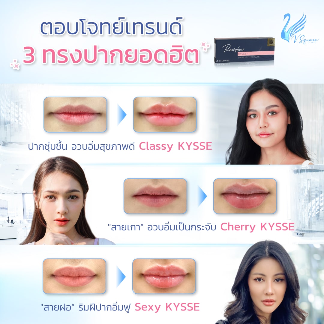 ฟิลเลอร์ Restylane Kysse รีวิว