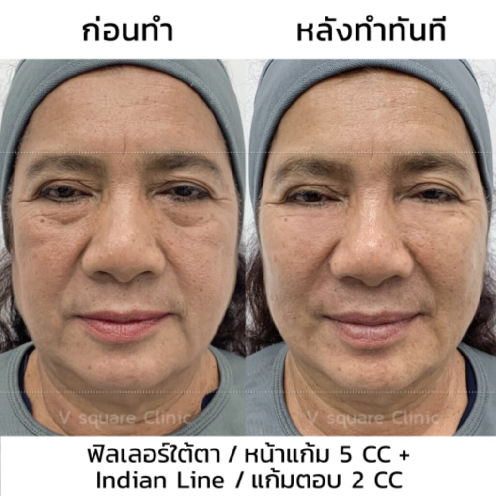 รีวิว Definisse 1