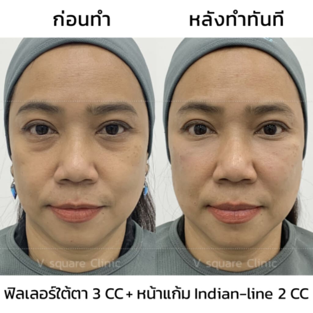 รีวิว Definisse 2