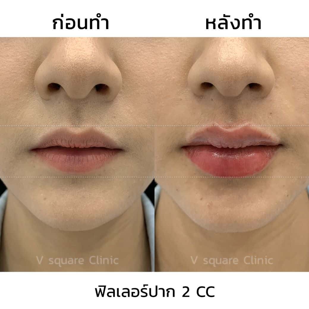 รีวิวฉีดฟิลเลอร์ Restylane ปาก(