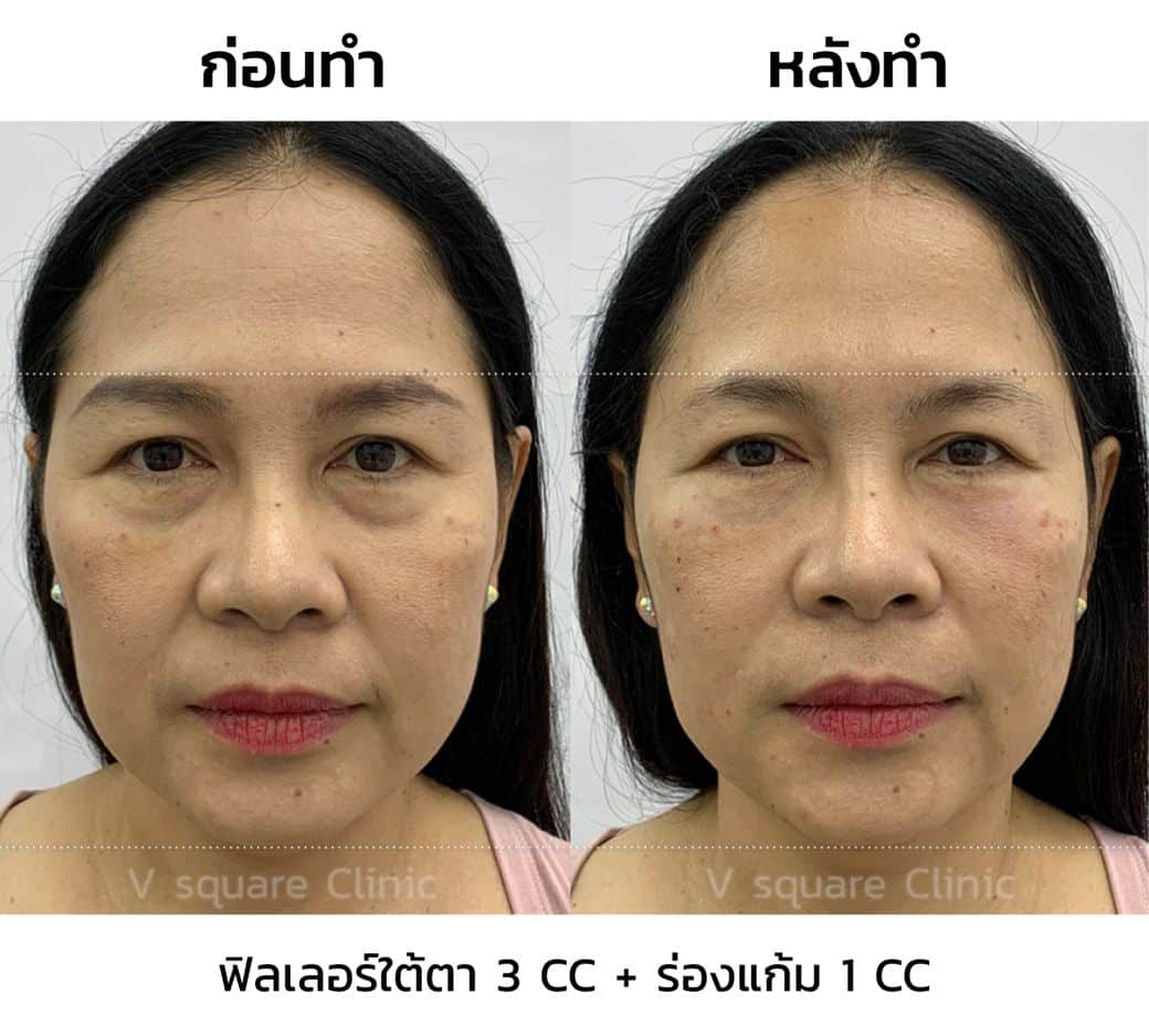 รีวิวฉีดฟิลเลอร์ Restylane ใต้ตา