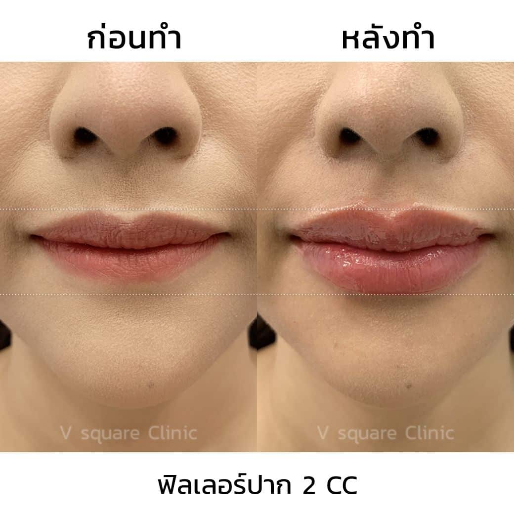 รีวิวฉีดฟิลเลอร์ยี่ห้อ Restylane