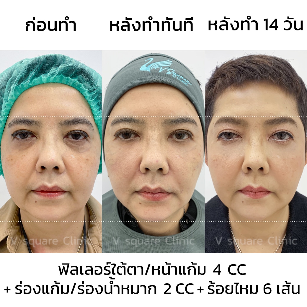 รีวิวฉีดฟิลเลอร์ร่องน้ำหมาก