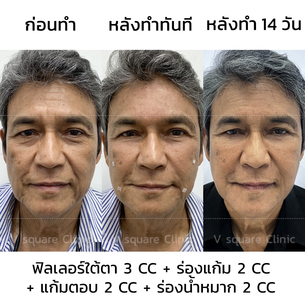 รีวิวฉีดฟิลเลอร์ร่องน้ำหมาก คุณไพโรจน์