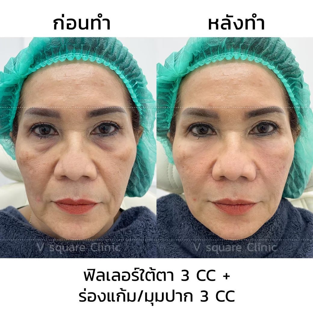 รีวิวฉีดฟิลเลอร์ร่องน้ำหมาก