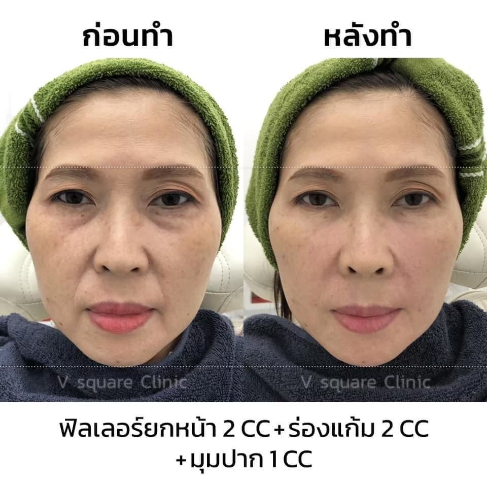 รีวิวฉีดฟิลเลอร์ร่องน้ำหมาก