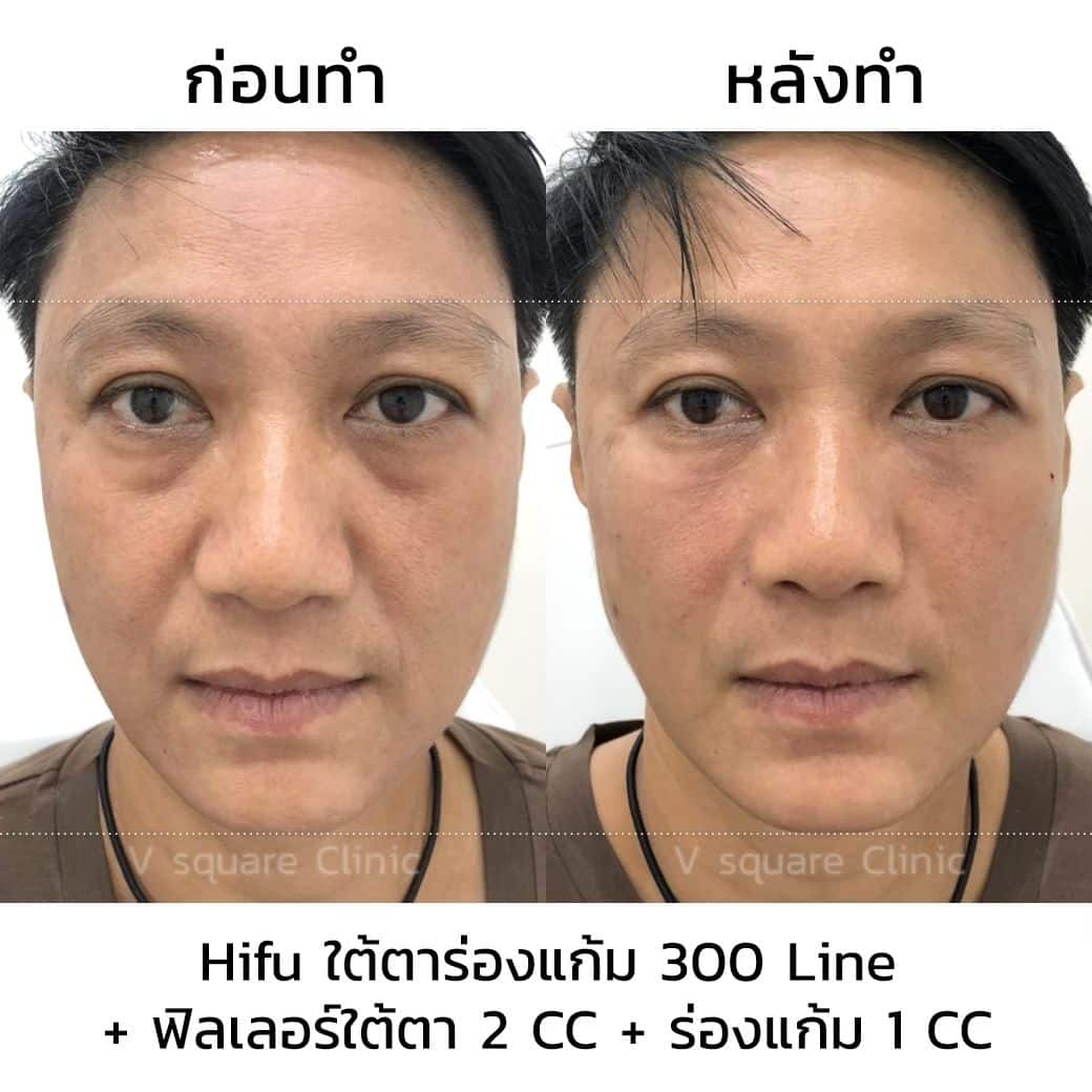 รีวิวฉีดฟิลเลอร์ร่องแก้มผู้ชาย