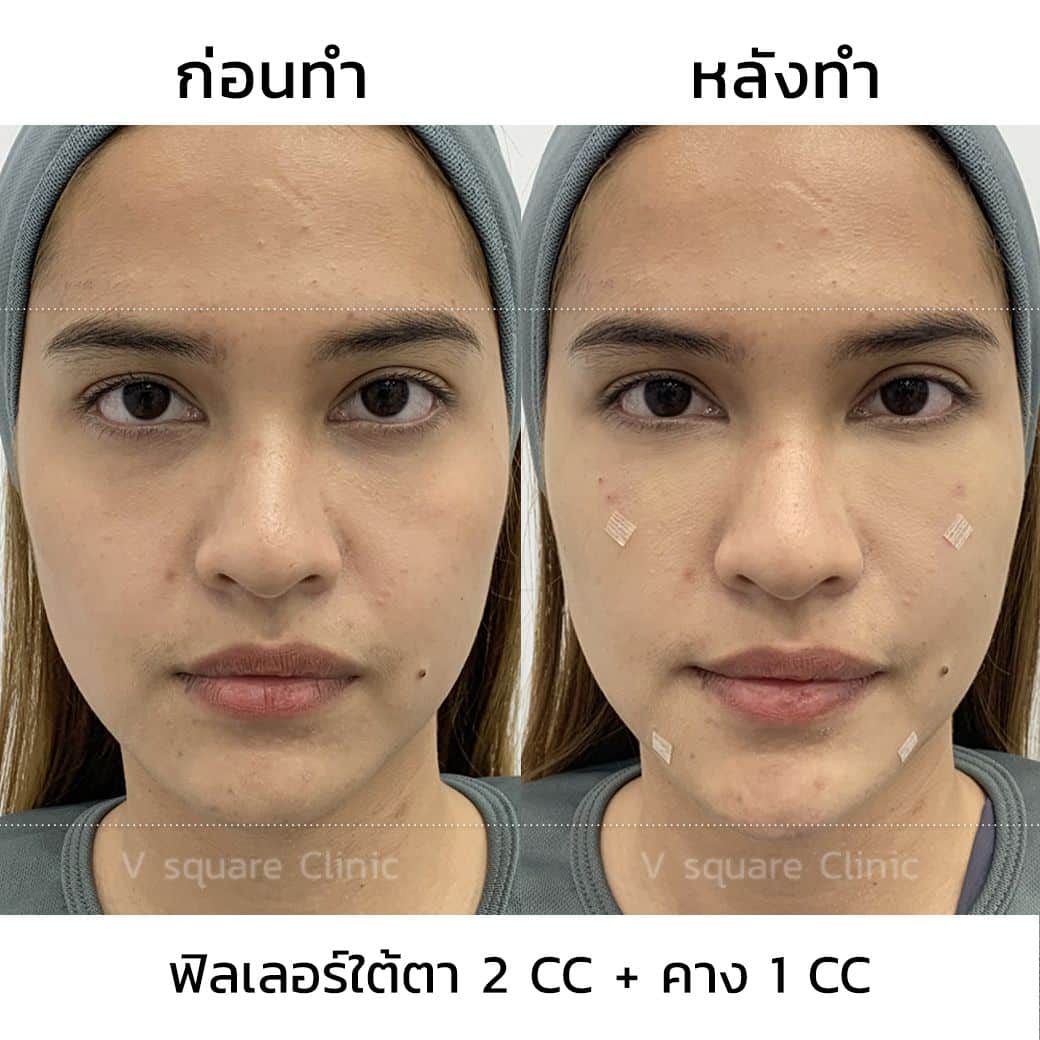 รีวิวฉีดฟิลเลอร์เรสเทอเรนใต้ตา