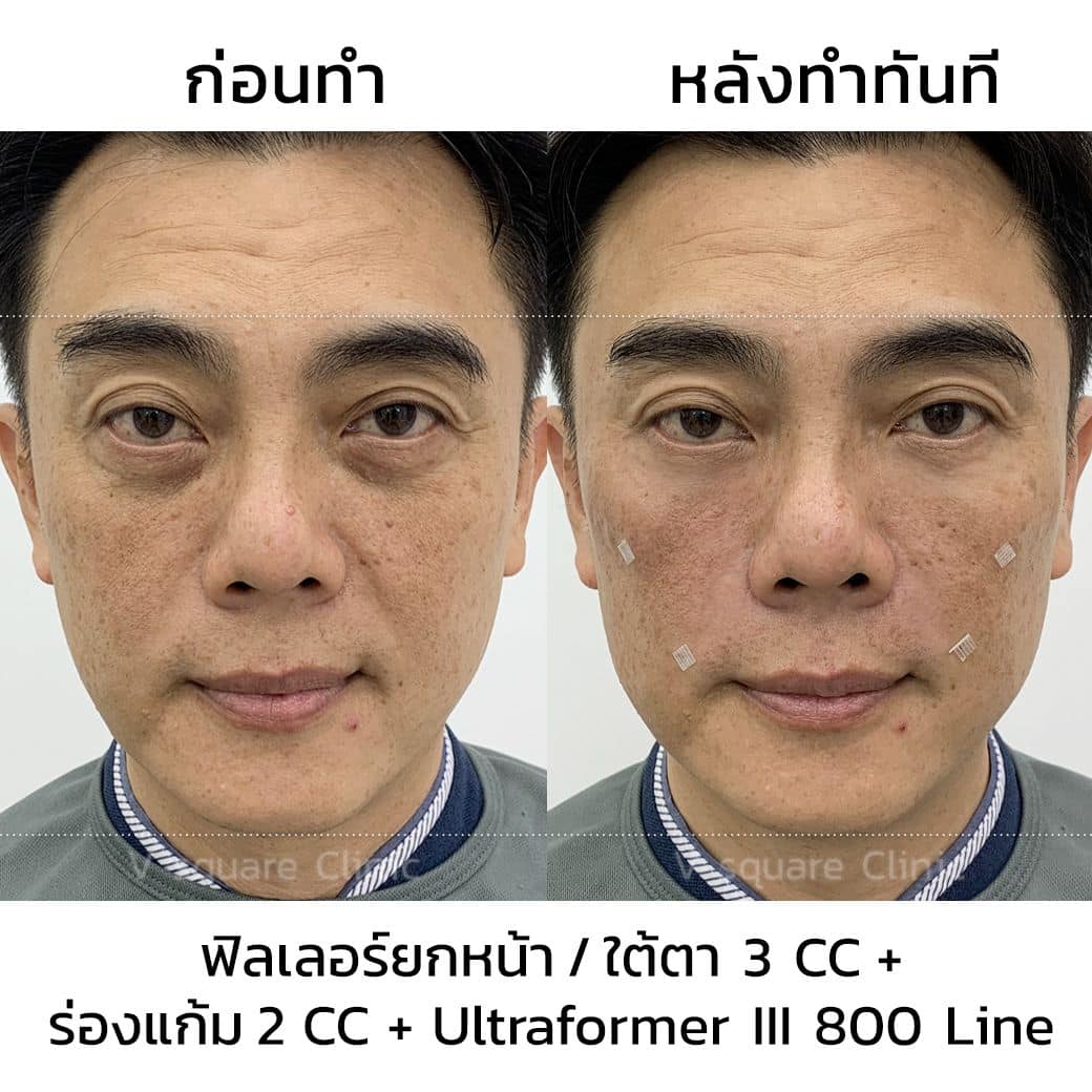 รีวิวฉีดฟิลเลอร์ใต้ตาผู้ชาย