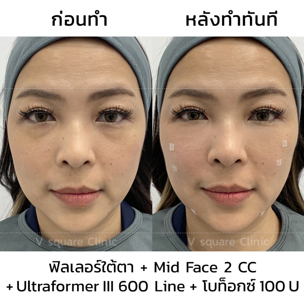 รีวิวฟิลเลอร์Juvederm