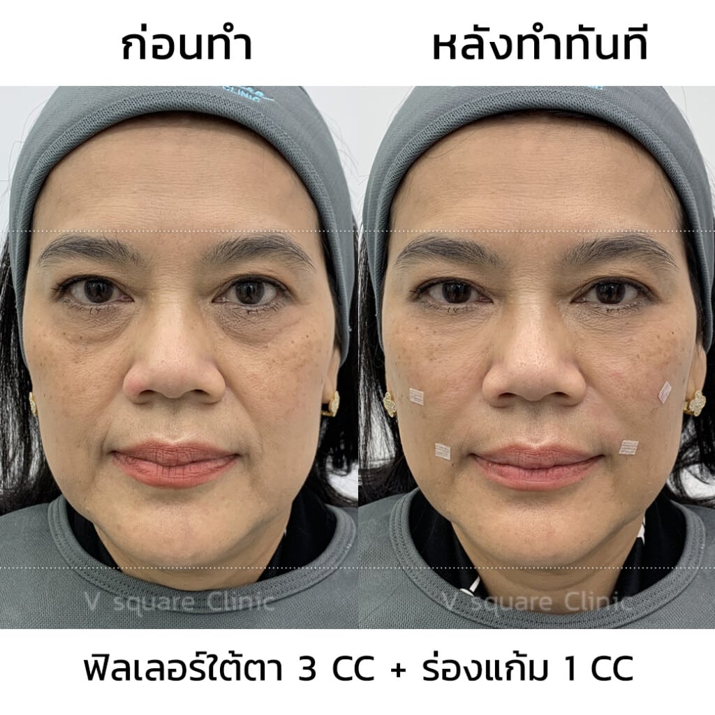 รีวิวฟิลเลอร์Juvederm