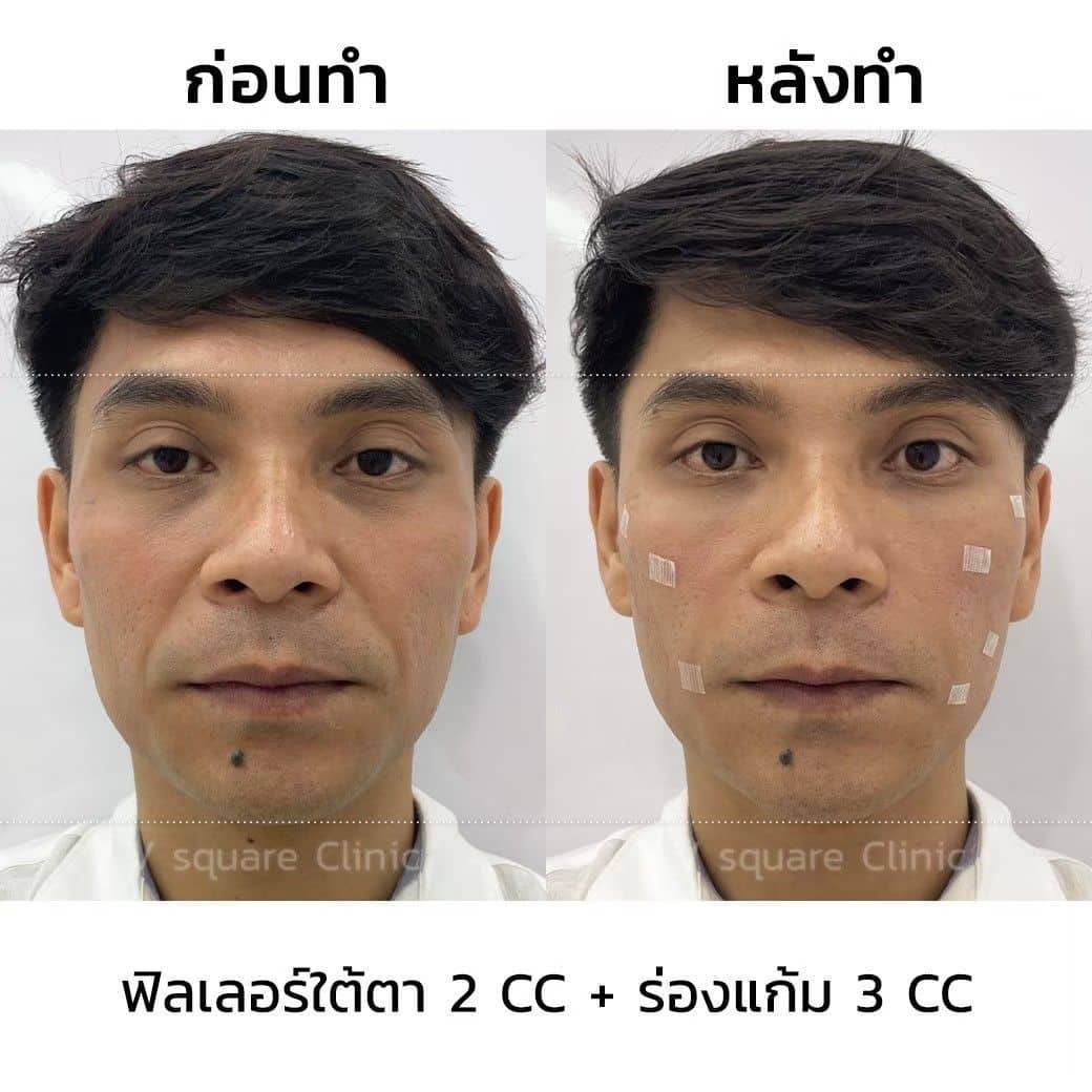 รีวิวฟิลเลอร์ร่องแก้มผู้ชาย