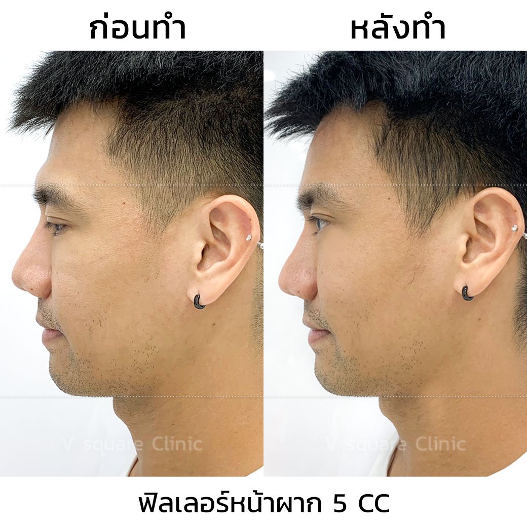 รีวิวฟิลเลอร์หน้าผากผู้ชาย โดย คุณพีช