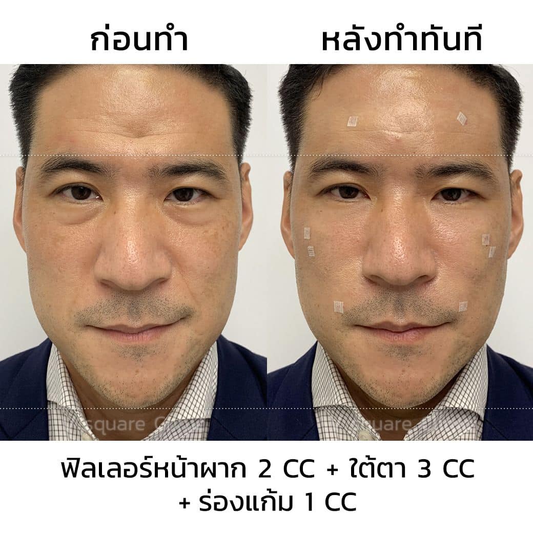 รีวิวฟิลเลอร์หน้าผากผู้ชาย