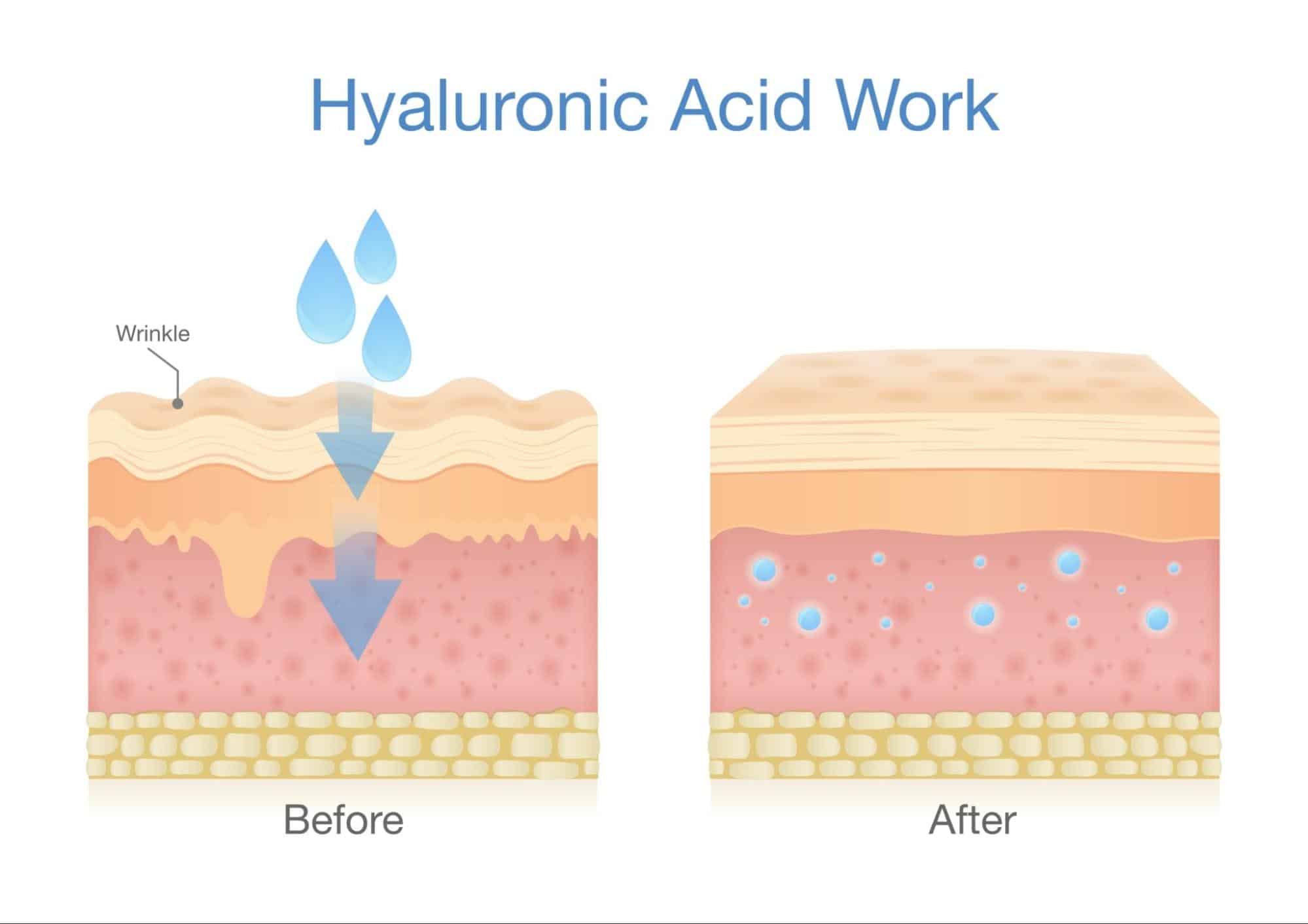 Hyaluronic Acid