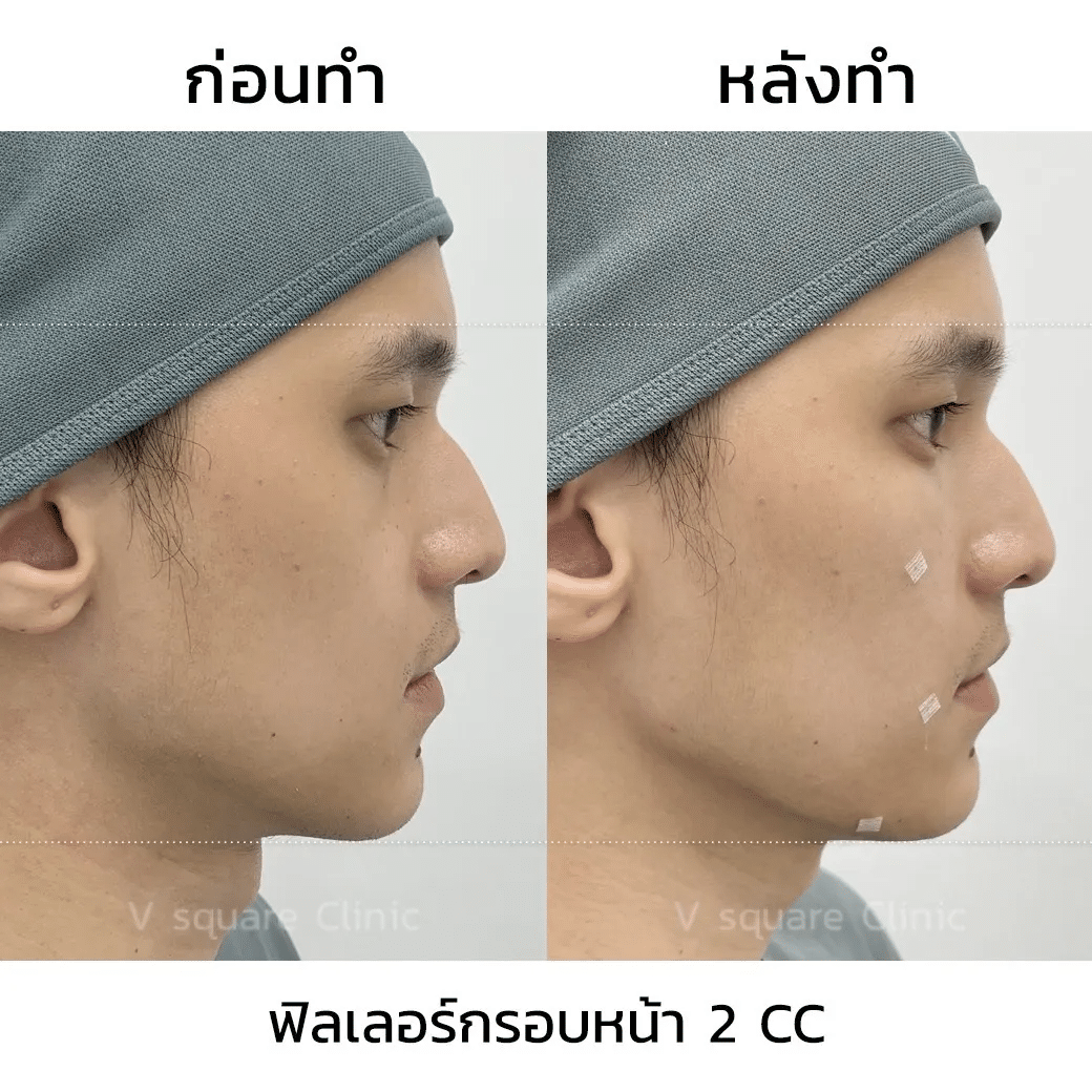 Juvederm Volux รีวิว