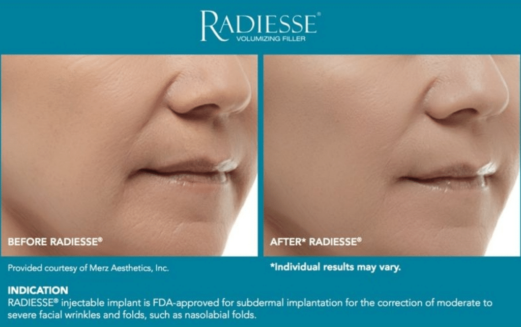 Radiesse Filler  รีวิว