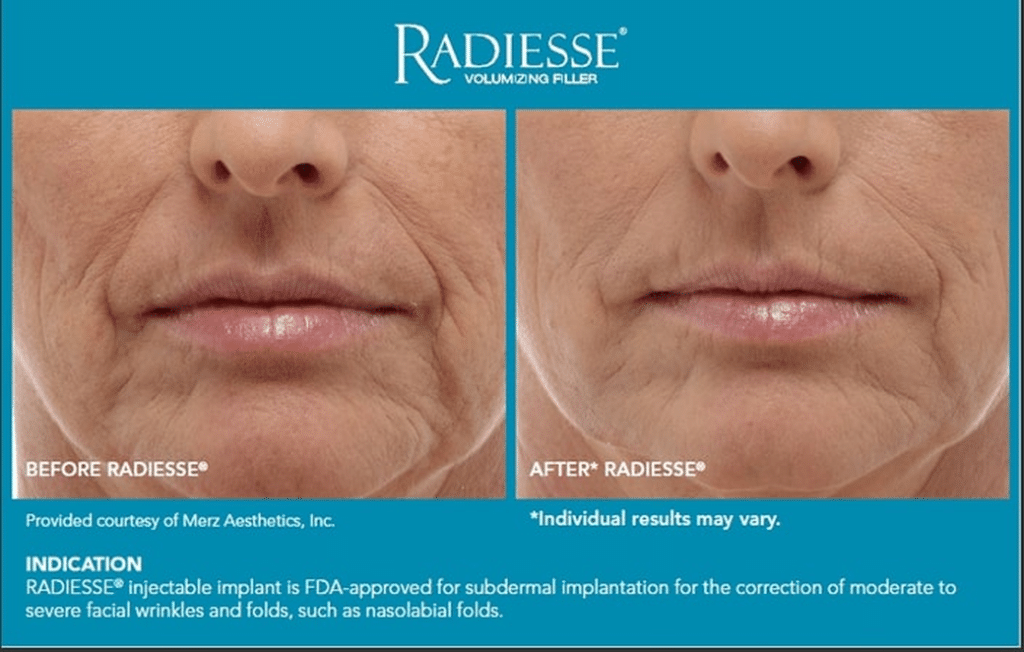 Radiesse Filler  รีวิว