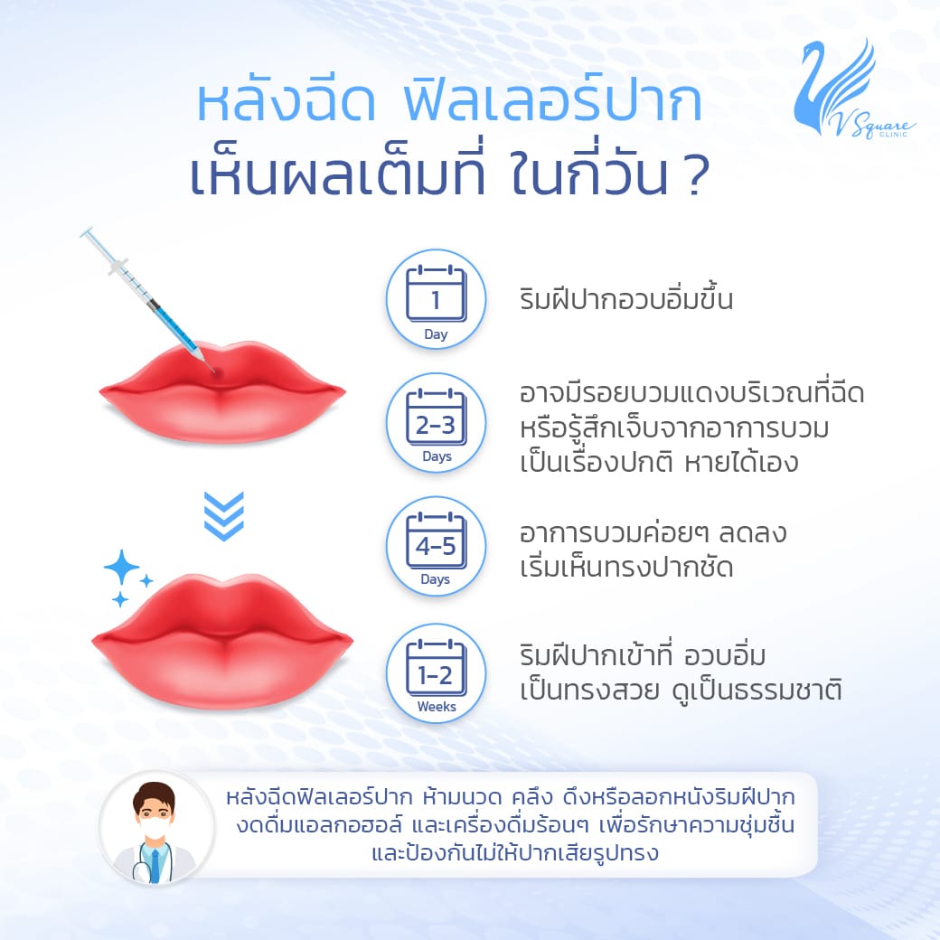 ฉีด Belotero Lips กี่วันเห็นผล ? อยู่ได้นานไหม ? 