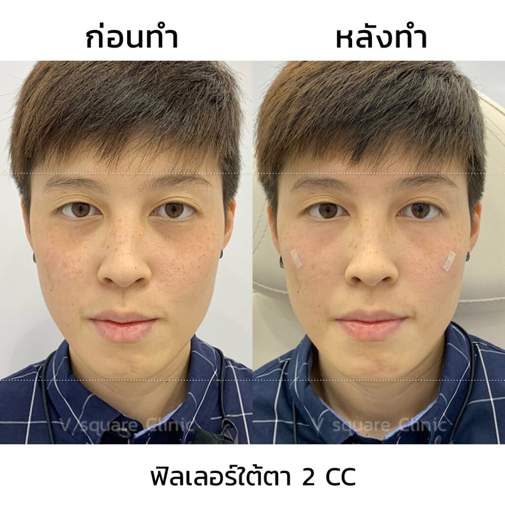 ฉีด Restylane Vital Light ใต้ตา